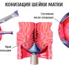 Секс После Прижигания