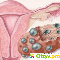 Мультифолликулярные яичники и беременность отзывы