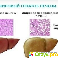 Жировой гепатоз печени отзывы
