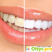 Отбеливание зубов отзывы фото до и после отзывы