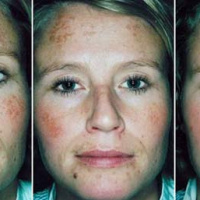 Лицо после озонотерапии фото Лицо после озонотерапии фото