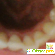 Чистка зубов ультразвуком - Чистка и пилинг - Фото 32052