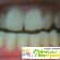 Чистка зубов ультразвуком - Чистка и пилинг - Фото 32053