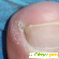 Операция по удалению вросшего ногтя на ноге - Разное (методы лечения) - Фото 33798