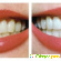 Отбеливание зубов White Light - Отбеливание зубов - Фото 69488