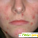 Аллергия на лице -  - Фото 185167