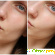 Ультразвуковая чистка лица до и после фото -  - Фото 230986