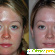 Ультразвуковая чистка лица до и после фото -  - Фото 230985