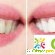 Tooth whitening -  - Фото 283861