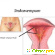 Эндометрит у женщин: виды, симптомы, лечение -  - Фото 362142