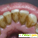 Зубной камень: удаление в клинике и домашних условиях -  - Фото 366237