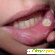 Ретенционная киста губы. Лечение - удаление на нижней -  - Фото 361158