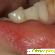 Ретенционная киста губы. Лечение - удаление на нижней -  - Фото 361159