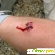 Рваная рана при укусе собаки -  - Фото 490492