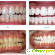 Отбеливание зубов отзывы фото до и после -  - Фото 586477