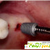 Зубные импланты отзывы пациентов отрицательные -  - Фото 588420