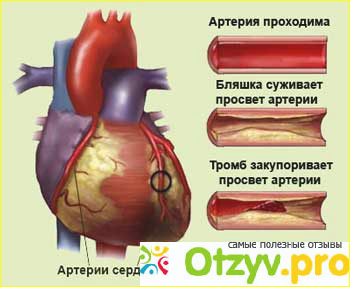 Отзыв о Ишемическая болезнь сердца