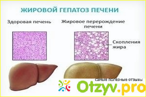 Отзыв о Жировой гепатоз печени