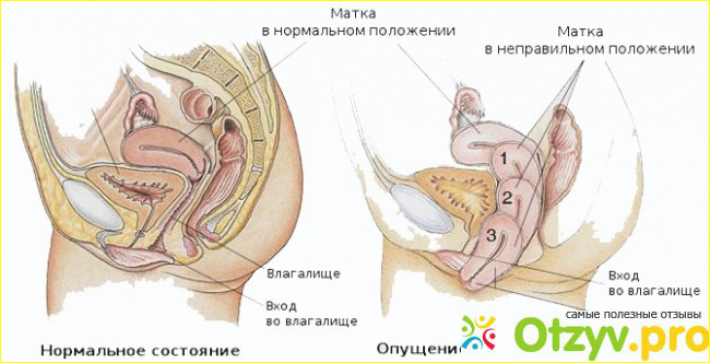 Как лечится от выпадения матки?