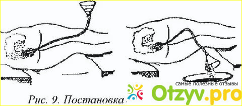 Отзыв о Клизма девушке