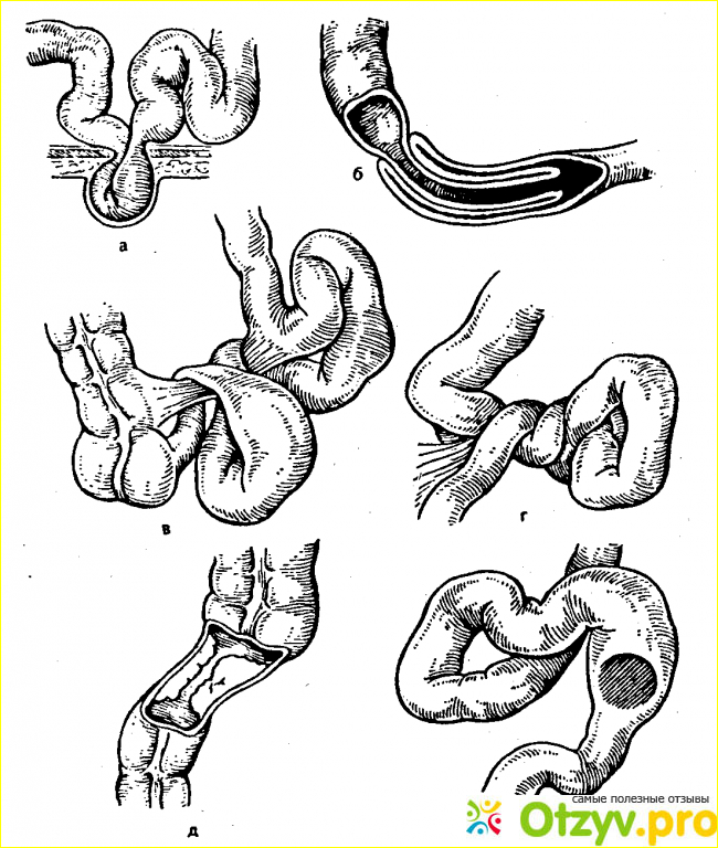 Кишечная непроходимость рекомендация. Кишечная непроходимость аскаридоз. Копростаз и кишечная непроходимость. Динамическая кишечная непроходимость. Динамическая непроходимость кишечника.