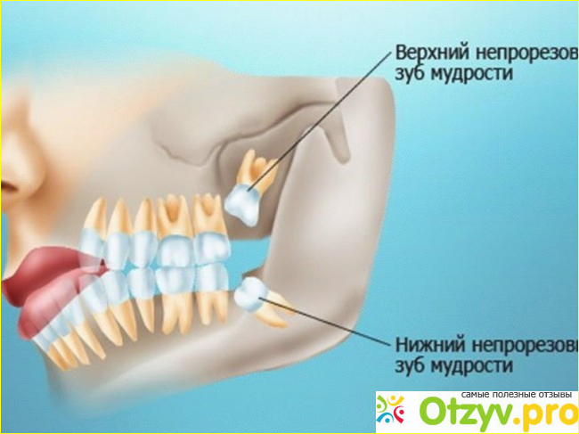Если после удаления зуба, болят другие органы