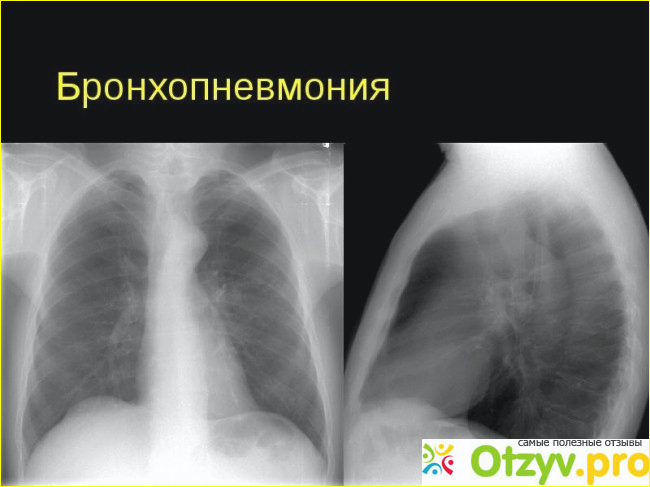 БРОНХОПНЕВМОНИЯ симптомы советы и инструкции 10:26 2024
