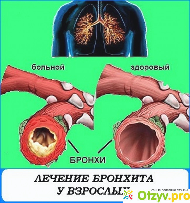 Бронхи симптомы. Что такое бронхит у взрослых.