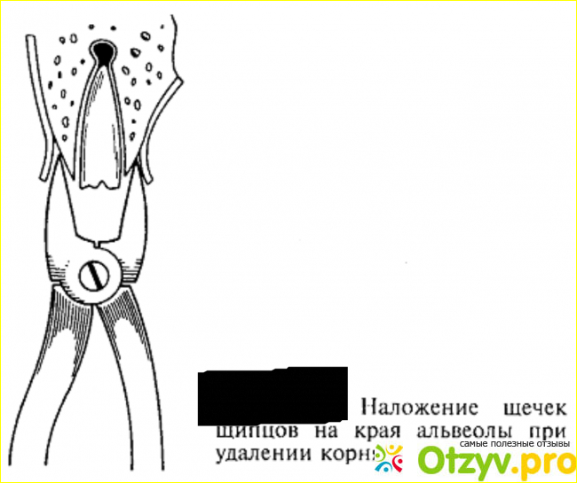 Противопоказание для резекции верхушки корня зуба