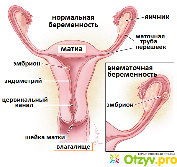 Тест на беременность при внематочной беременности.