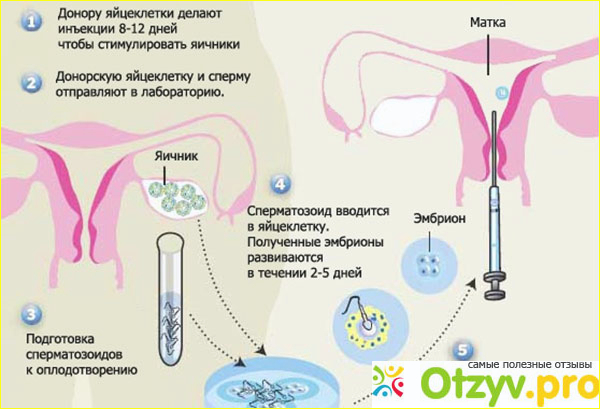Как стать донором яйцеклетки? 