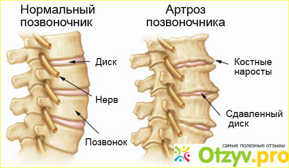  Отображение болезни позвоночника. 