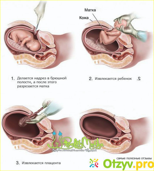 Кесарево фото1