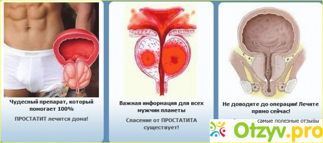Какой Секс При Простатите