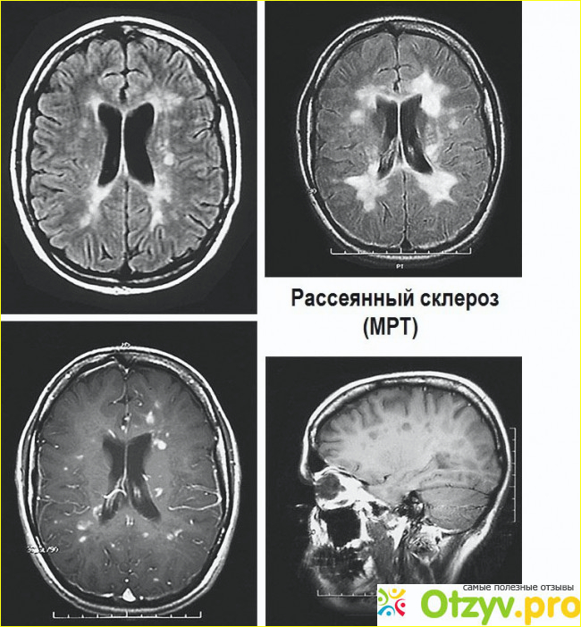 Показания к применению препарата Копаксон