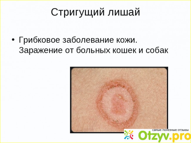 Лечение стригущего лишая на коже