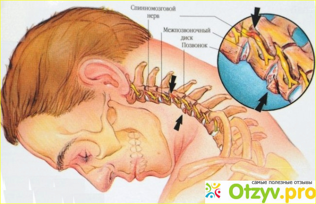 Остеохондроз фото1