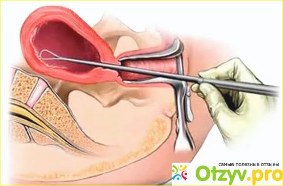 Отзыв о Как подготовиться к диагностическому выскабливанию матки?