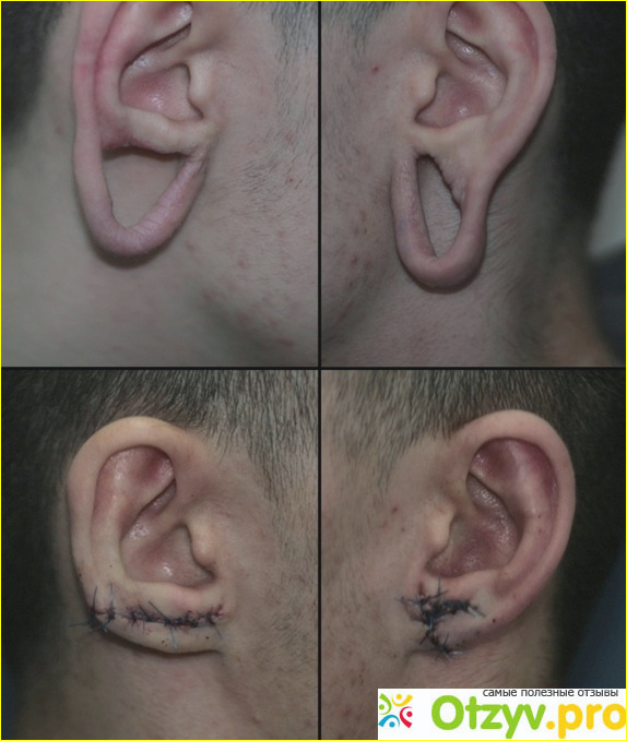 Отзыв о Пирсинг - тоннель мочки уха