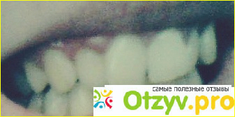 Отзыв о Чистка зубов ультразвуком