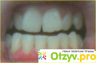 Чистка зубов ультразвуком фото2