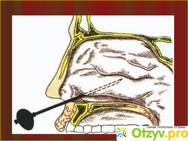 Отзыв о Прокол гайморовых пазух