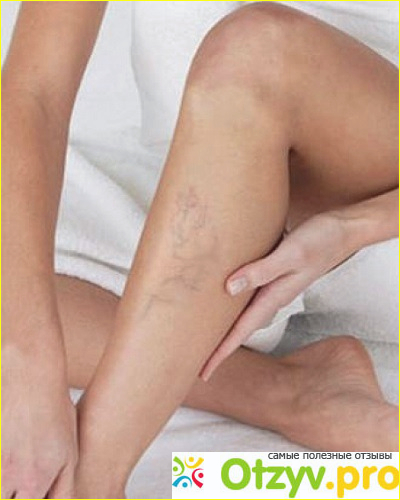 Сream Of Varicose Veins отзывы врачей и пациентов