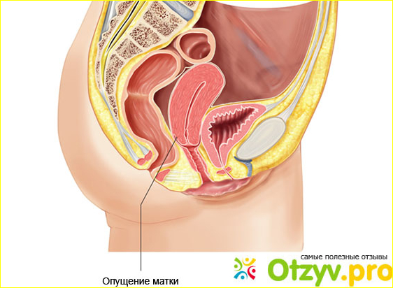 Отзыв о Опущение влагалища