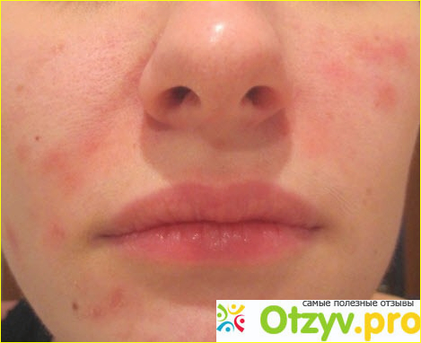 Отзыв о Аллергия на лице