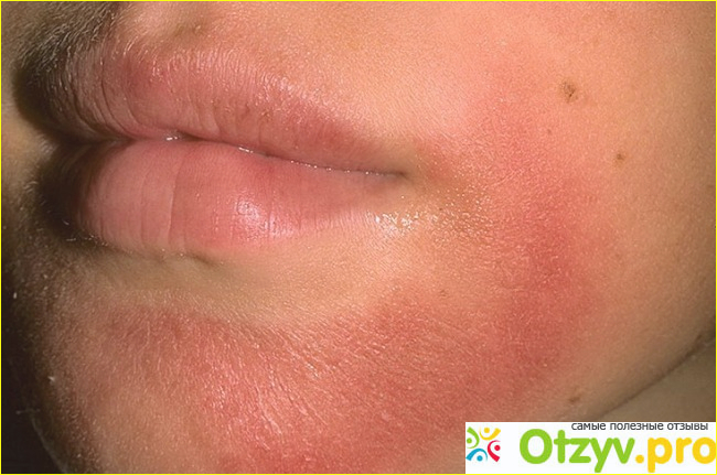 Аллергия на лице фото2