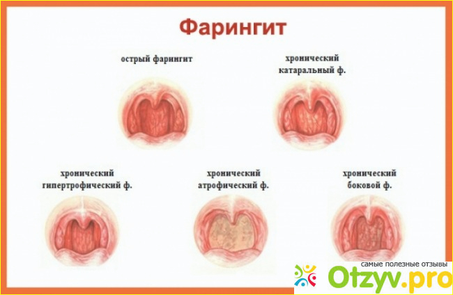 Отзыв о Фарингит симптомы