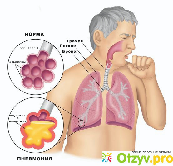 Отзыв о Воспаление лёгких симптомы