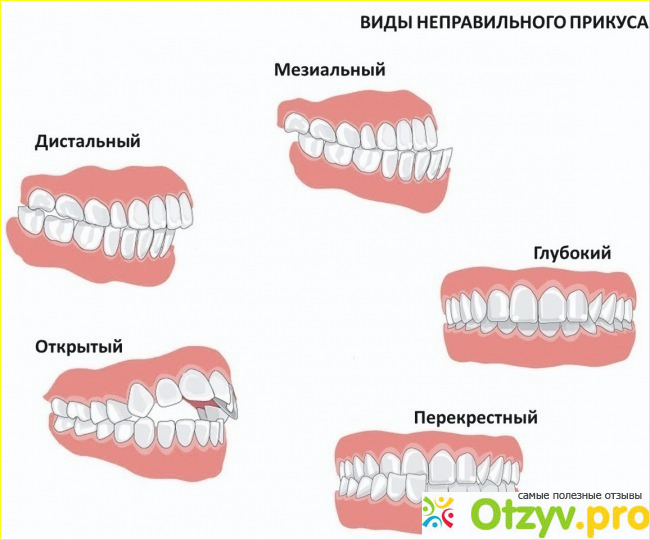 Отзыв о Исправление прикуса брекетами