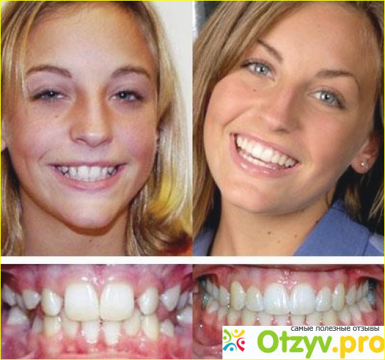 Отзыв о Исправление прикуса у взрослых
